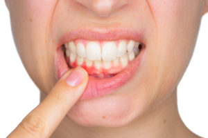歯茎 押す と 痛い 前歯