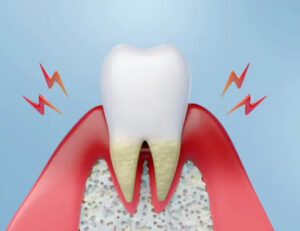 下高井戸の歯医者、カズデンタルクリニックで歯周病の急性発作についての解説