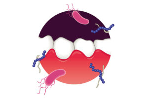 下高井戸の歯医者、カズデンタルクリニックで歯周病の急性発作についての解説